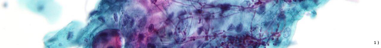 Candida auf Pap-Test